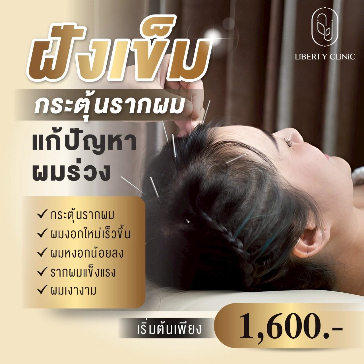 ฝังเข็ม กระตุ้นรากผม ผมร่วง
