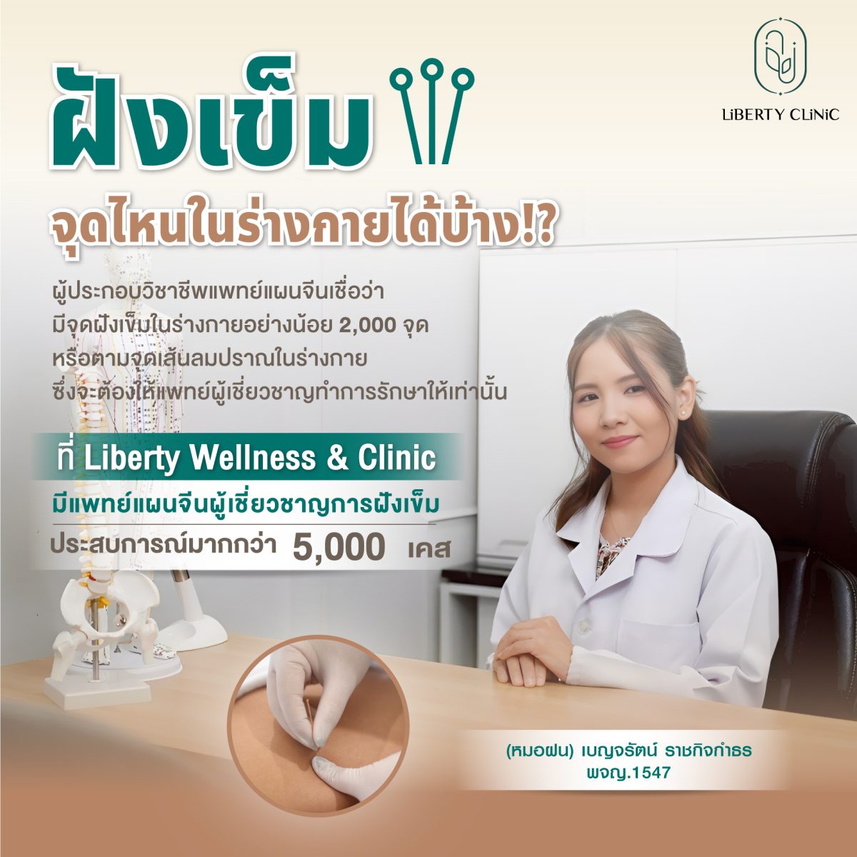 ฝังเข็ม จุดไหนได้บ้าง