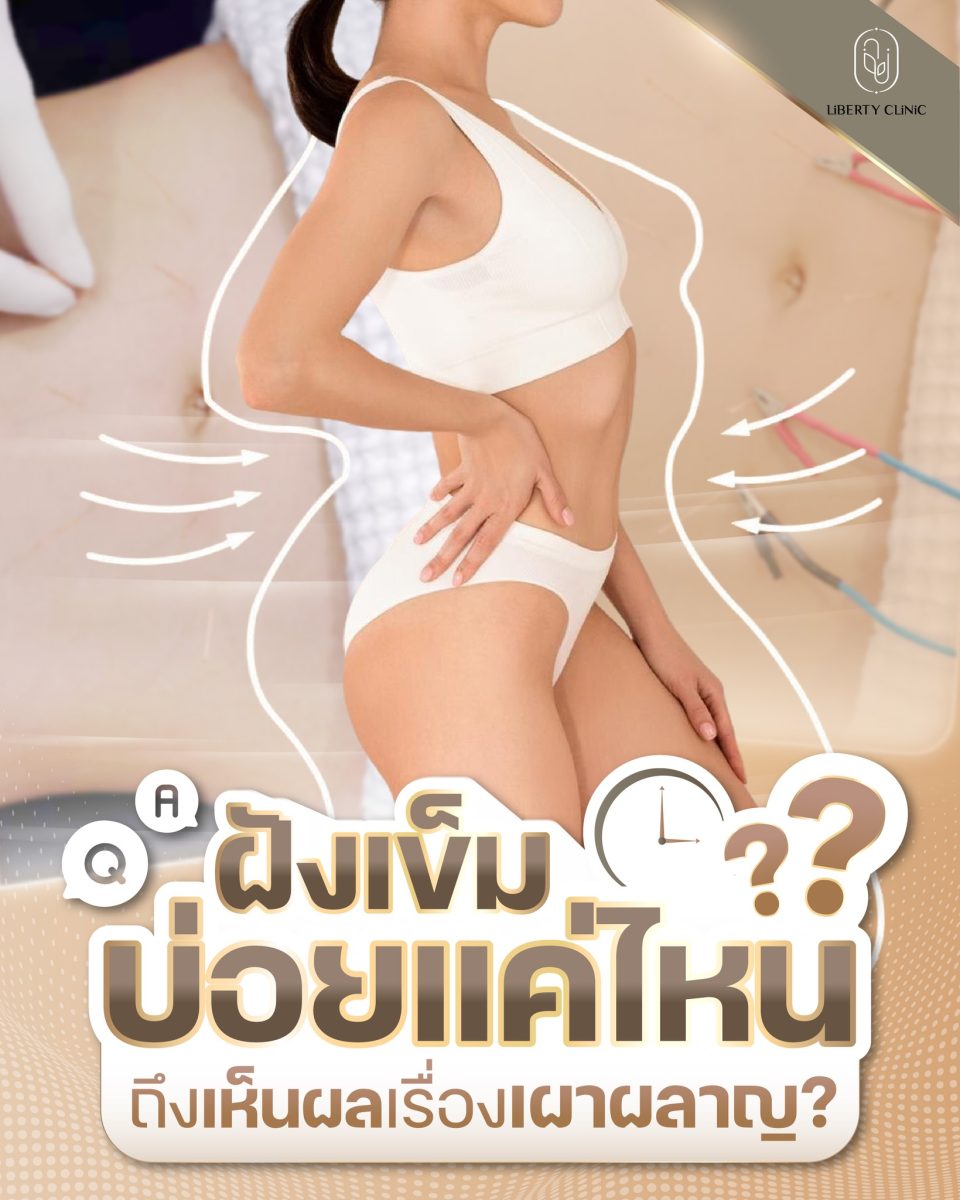 ฝังเข็มกระตุ้นเผาผลาญ